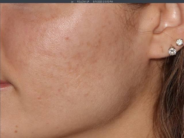 After Charcoal Facial After Charcoal Facial