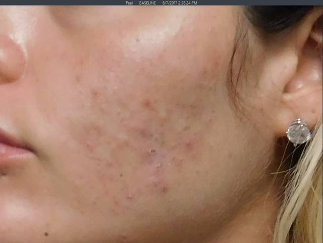 Before Charcoal Facial Before Charcoal Facial