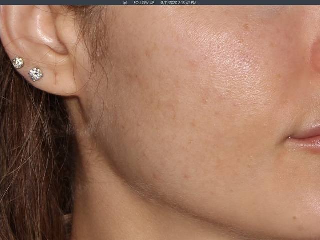 After Charcoal Facial After Charcoal Facial