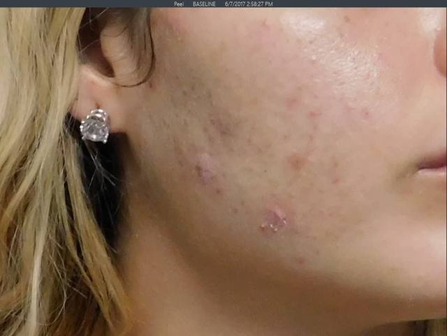 Before Charcoal Facial Before Charcoal Facial
