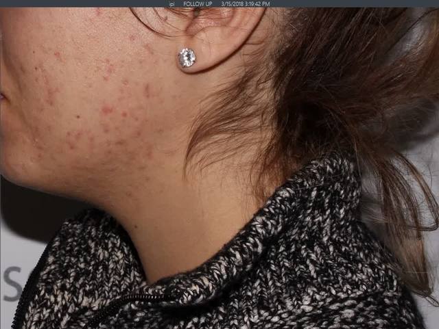 After Chemical Peel After Chemical Peel