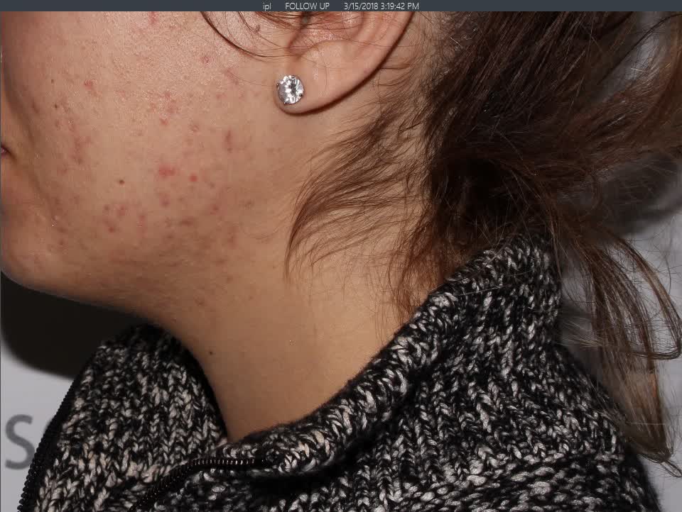 After Chemical Peel After Chemical Peel