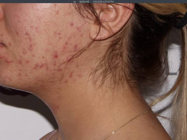 Before Chemical Peel Before Chemical Peel