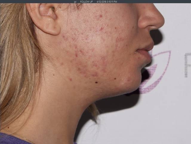 After Chemical Peel After Chemical Peel