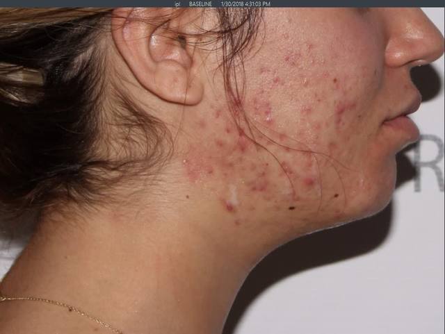 Before Chemical Peel Before Chemical Peel