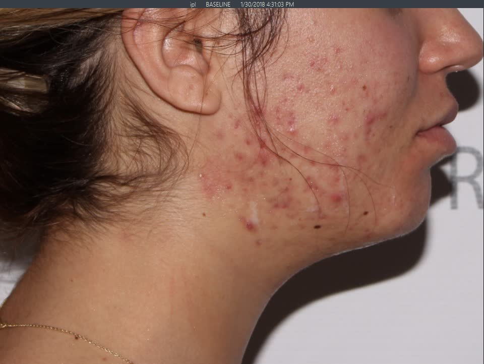 Before Chemical Peel Before Chemical Peel