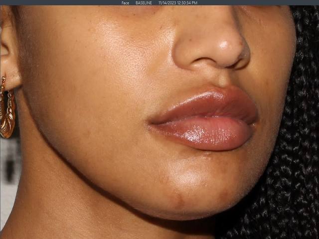 After Pigment Correction After Pigment Correction