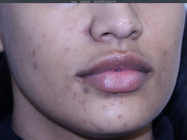 Before Pigment Correction Before Pigment Correction