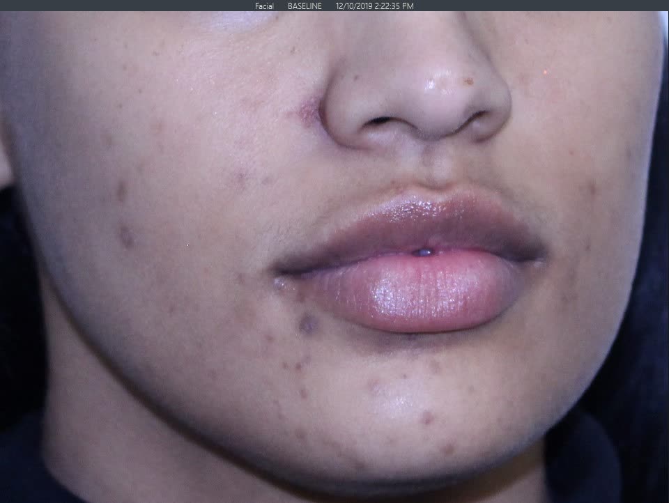 Before Pigment Correction Before Pigment Correction