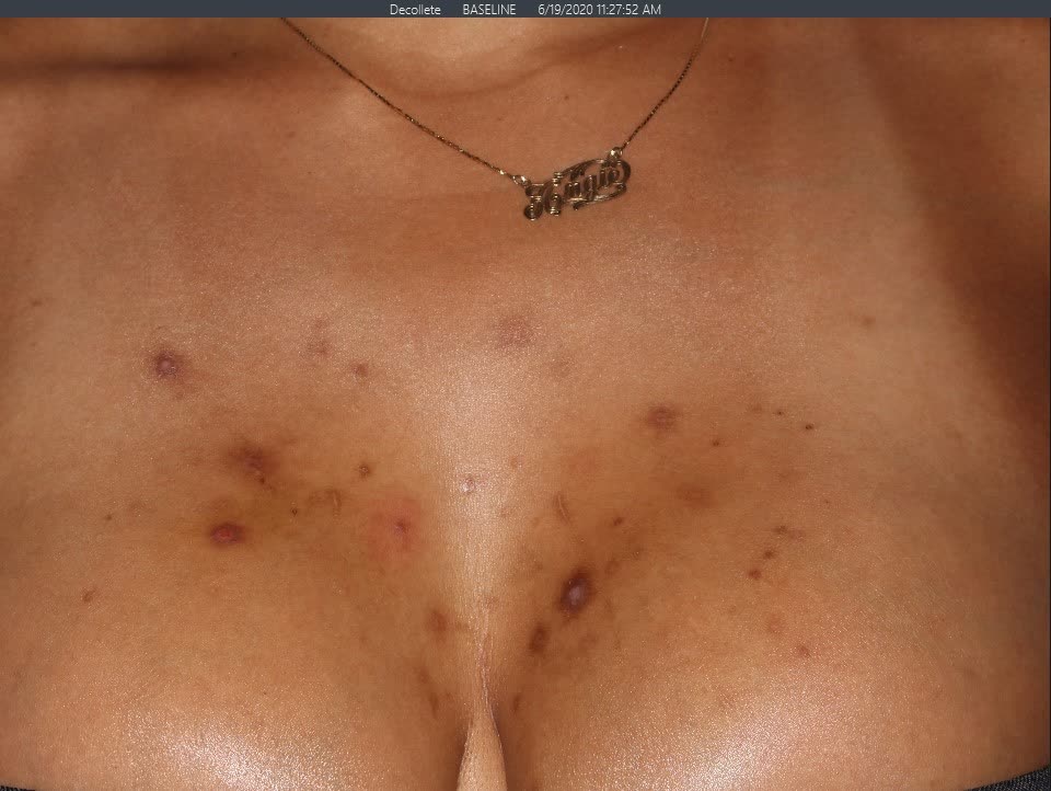 Before Pigment Correction Before Pigment Correction