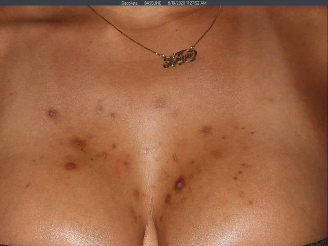 Before Pigment Correction Before Pigment Correction