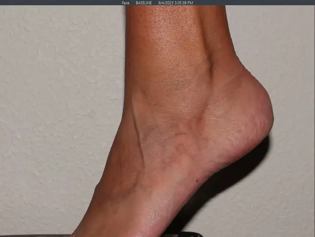 After Tattoo Removal After Tattoo Removal