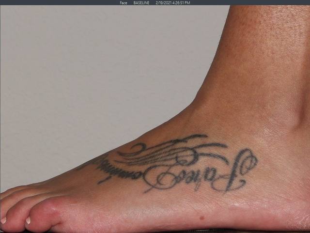 Before Tattoo Removal Before Tattoo Removal