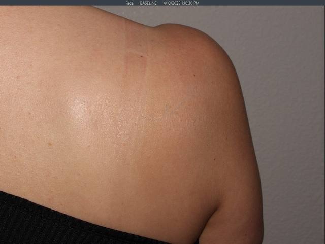 After Tattoo Removal After Tattoo Removal
