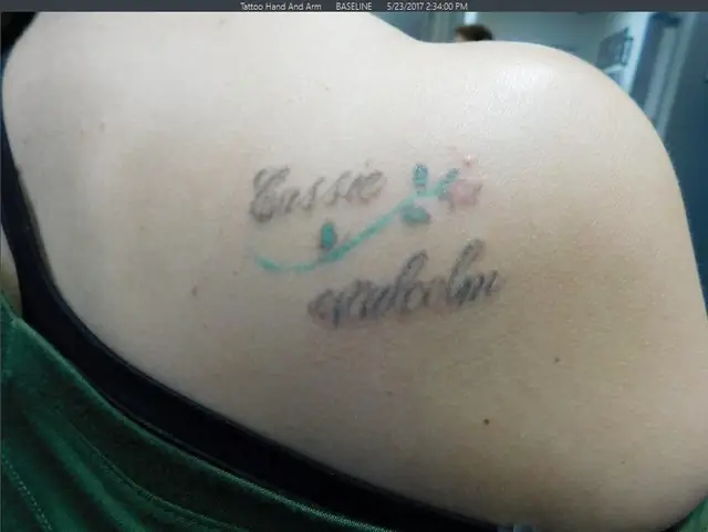 Before Tattoo Removal Before Tattoo Removal