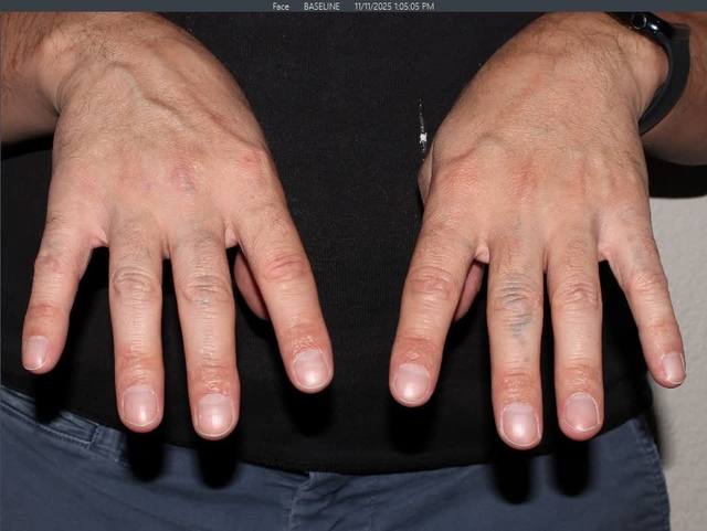 After Tattoo Removal After Tattoo Removal