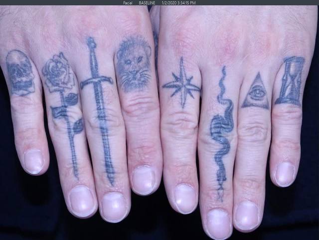 Before Tattoo Removal Before Tattoo Removal