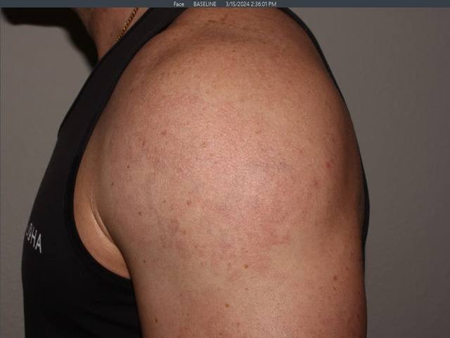 After Tattoo Removal After Tattoo Removal