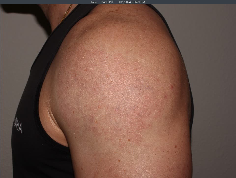 After Tattoo Removal After Tattoo Removal