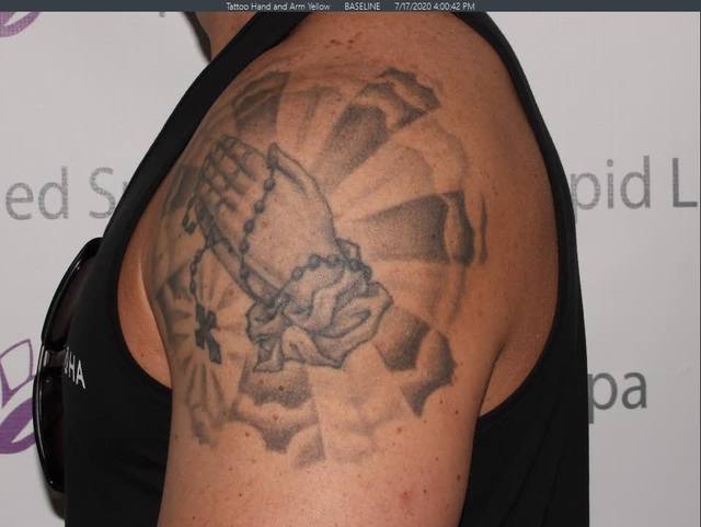 Before Tattoo Removal Before Tattoo Removal
